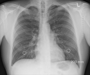 US race-neutral lung assessments to have profound effects, study finds