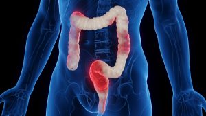 Researchers discover major cause of inflammatory bowel disease