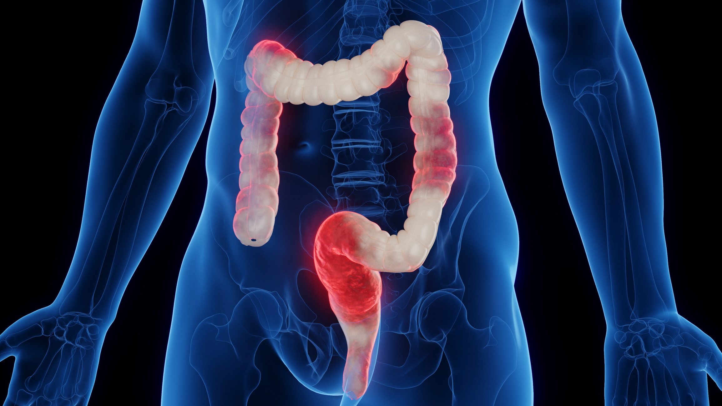 Researchers discover major cause of inflammatory bowel disease