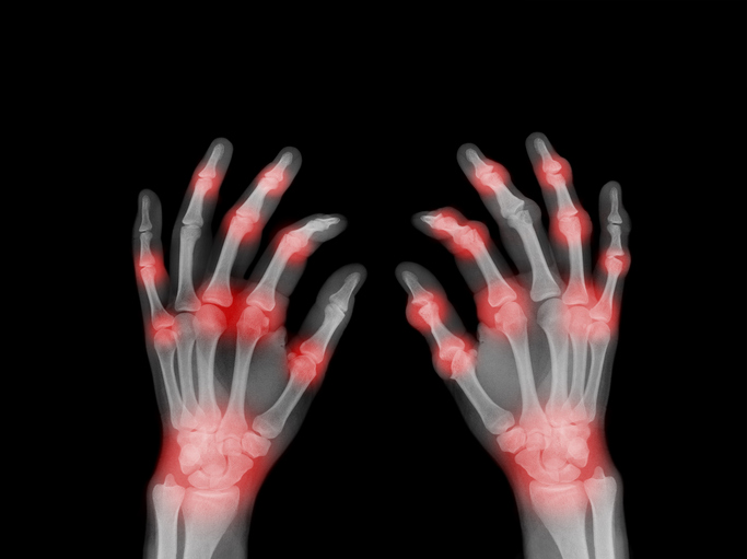 Gut microbiome changes may signal onset of rheumatoid arthritis