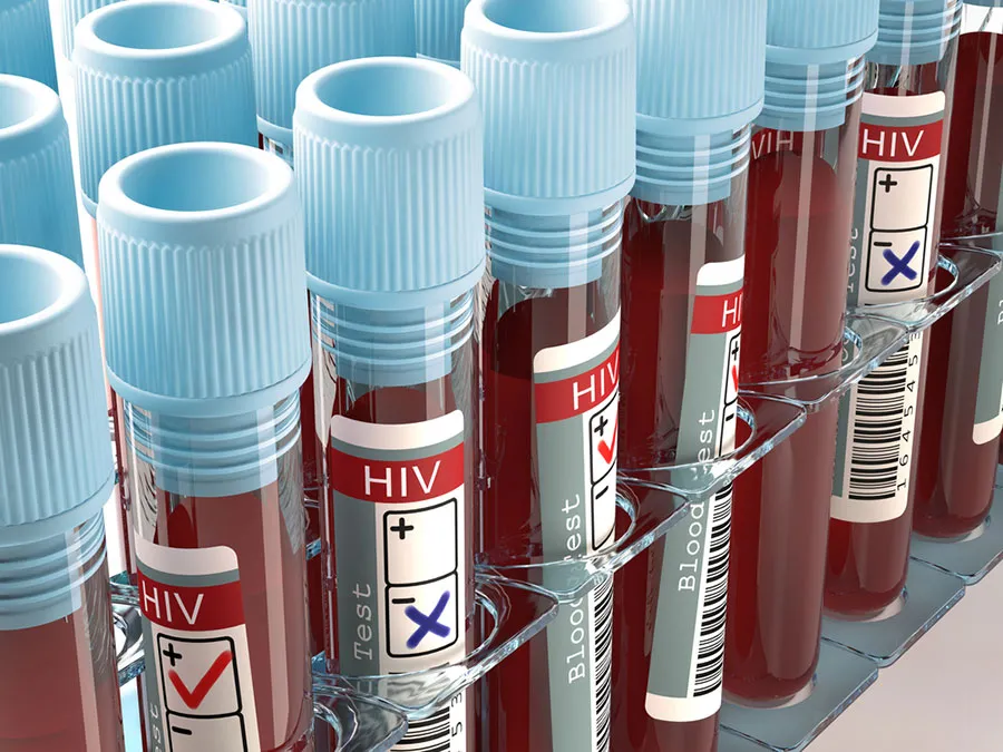 Global HIV funding cuts could lead to over 10 million infections, 3 million deaths by 2030: Lancet