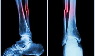 Routine bone scans may soon reveal hidden heart disease risks