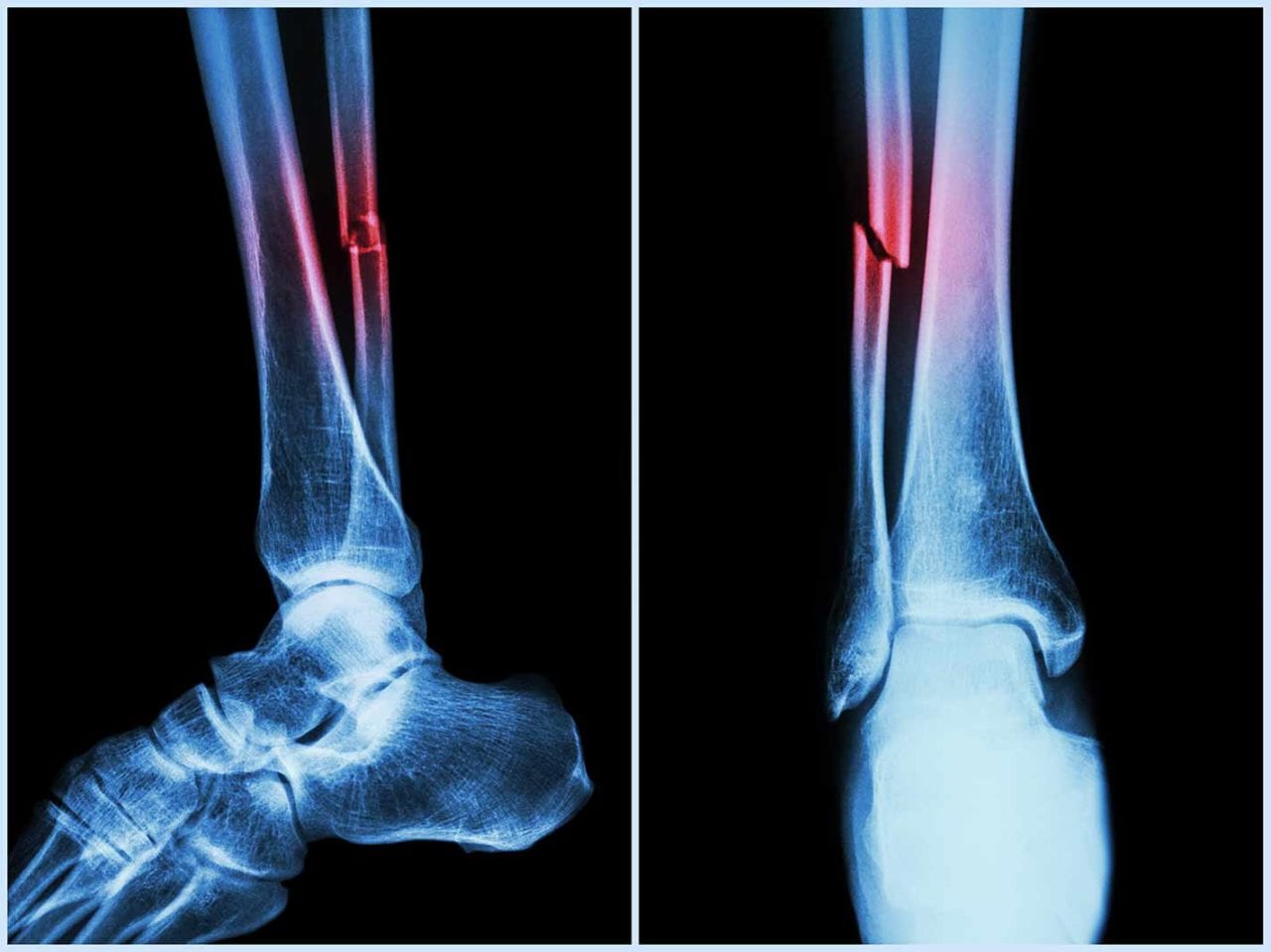 Routine bone scans may soon reveal hidden heart disease risks