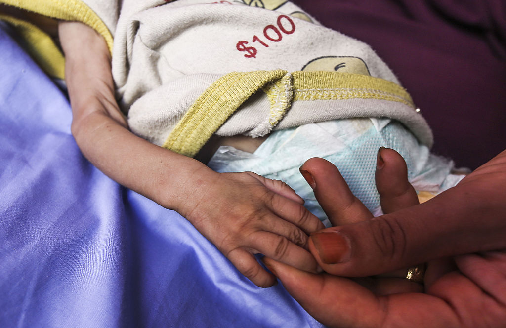 On Gaza malnutrition ward, a child’s arm is as wide as mother’s thumb