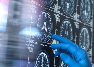 Australia dementia cases to top one million by 2065