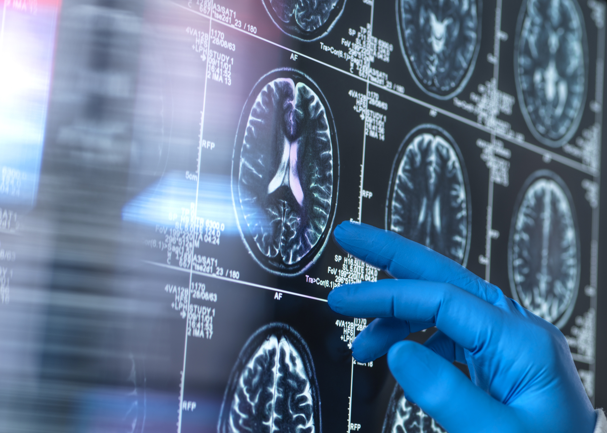 Australia dementia cases to top one million by 2065