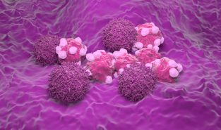 Preventable cervical cancer kills a woman every two minutes: UN