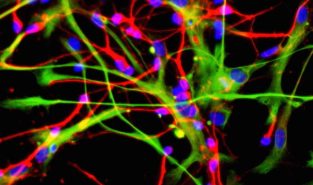 Fat-Derived Stem Cells Show Promise in Healing Spinal Fractures: Osaka Study