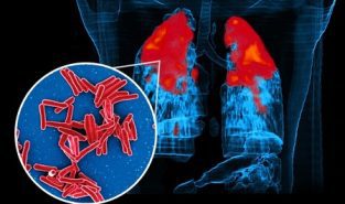 IIT Bombay study reveals how TB bacteria shield themselves from antibiotics, survive longer