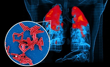 IIT Bombay study reveals how TB bacteria shield themselves from antibiotics, survive longer