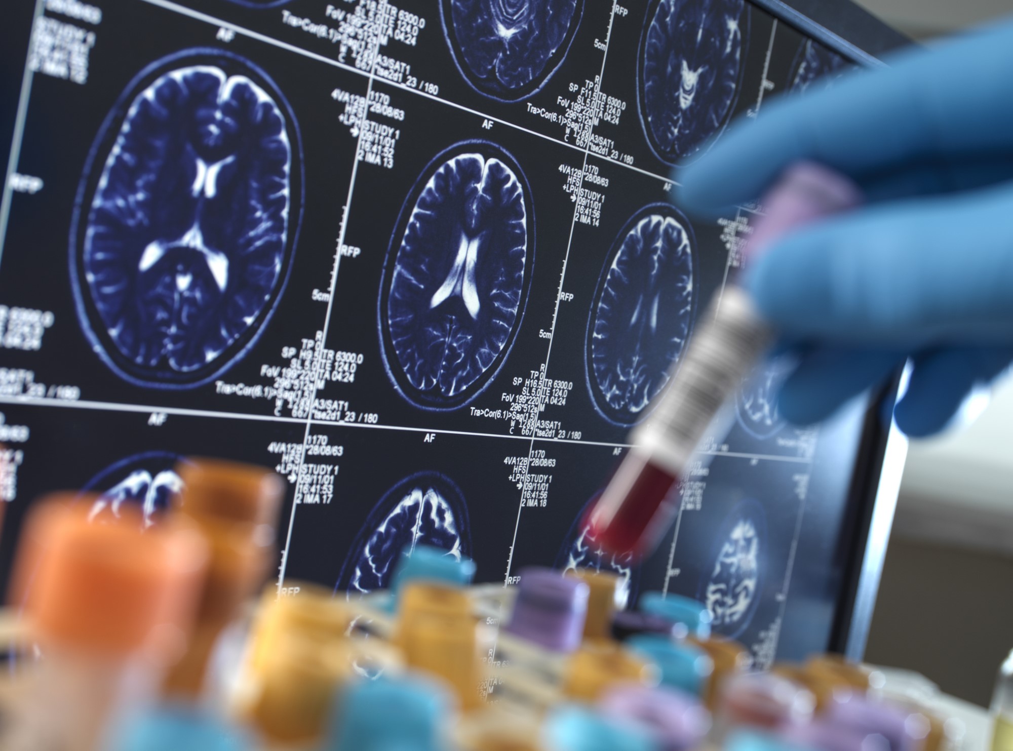 Indian researchers develop nanoparticle-based multi-target therapy for Alzheimer’s