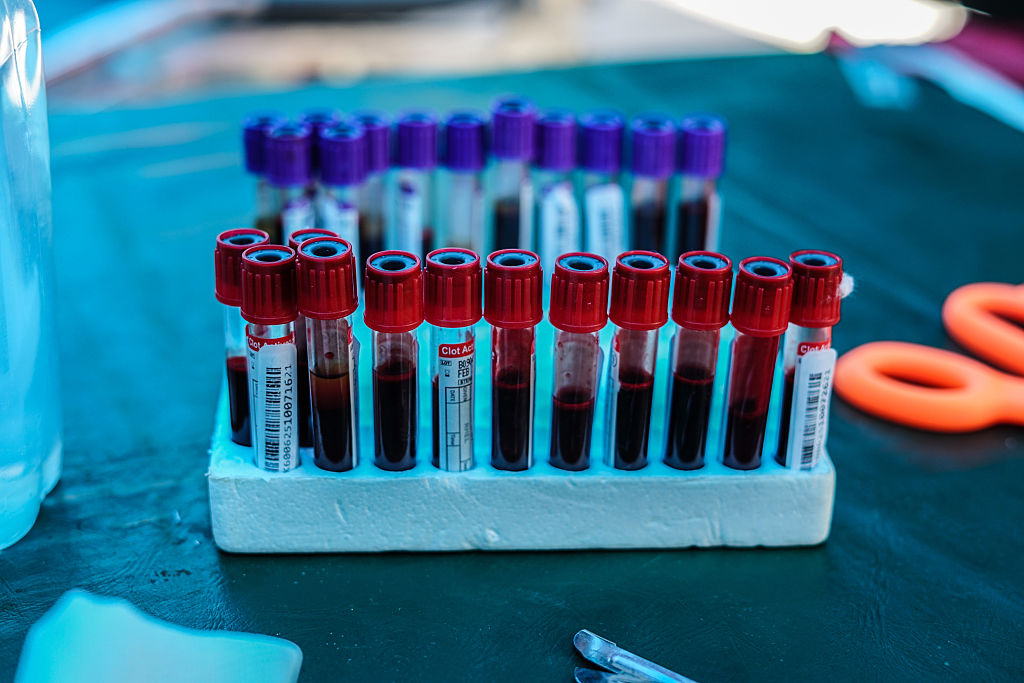 New blood test can detect, monitor lung cancer in real time