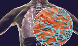 JOSH teams to be rolled out across 55 districts in 11 states to boost TB awareness