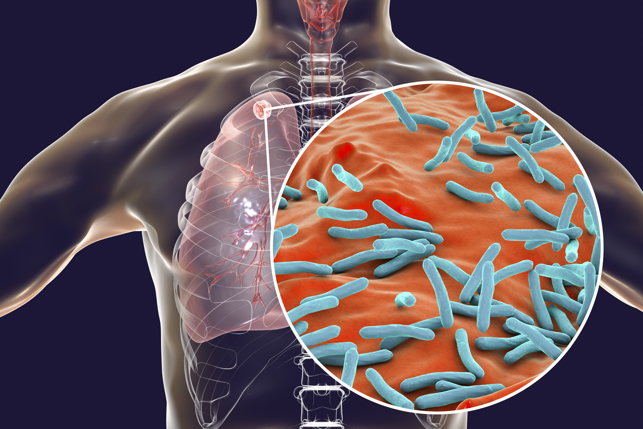 JOSH teams to be rolled out across 55 districts in 11 states to boost TB awareness